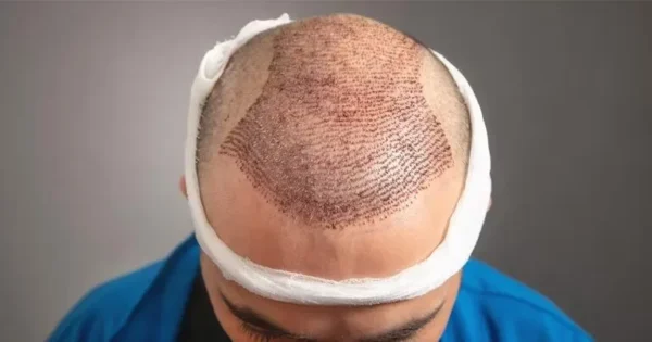 Is hair transplant in Dubai a smart move?